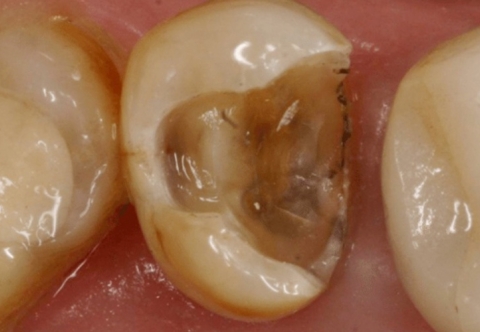 Bật mí những cách khắc phục răng hàm bị vỡ hiệu quả