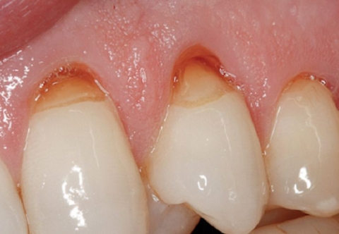Triệu chứng mòn cổ chân răng và biện pháp phòng ngừa