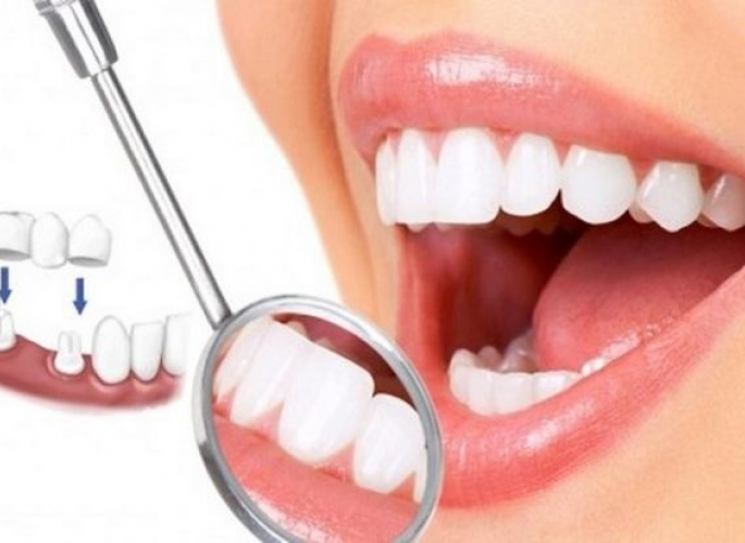 Răng sứ thẩm mỹ 