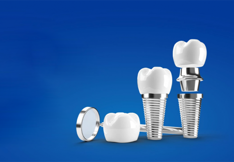 Mất răng không còn là nỗi lo với phương pháp trồng răng Implant