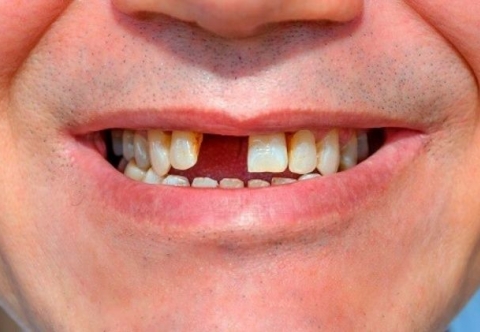 Mất răng cửa có thể gây ra những tác hại gì? những lưu ý khi trồng răng cửa