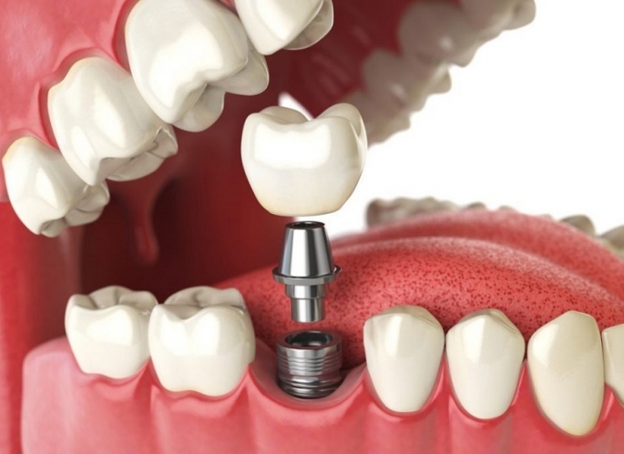 Trồng răng Implant