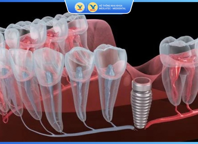 Kỹ thuật Implant All On