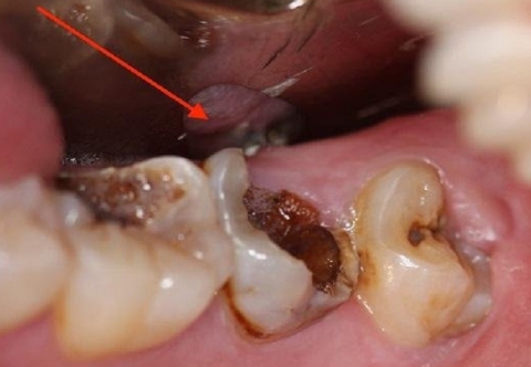 Nguyên nhân, dấu hiệu nhận biết và biện pháp điều trị mục răng
