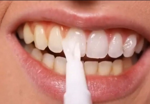 Những điều cần biết về gel trắng răng tại nhà