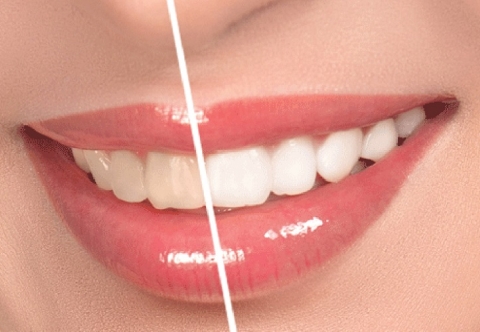 Cách làm trắng răng bị vàng để lấy lại hàm răng sáng bóng