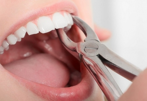 Nhổ răng bao lâu thì lành? Nên kiêng ăn gì?