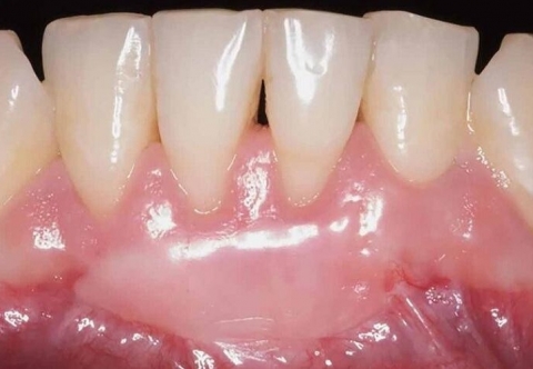 Nguyên nhân và cách khắc phục tụt nướu răng