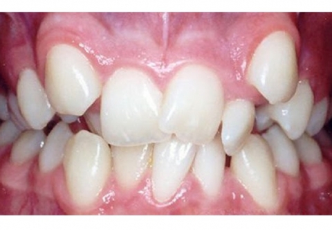 Răng lồi xỉ có hình dạng thế nào? Điều trị ra sao?