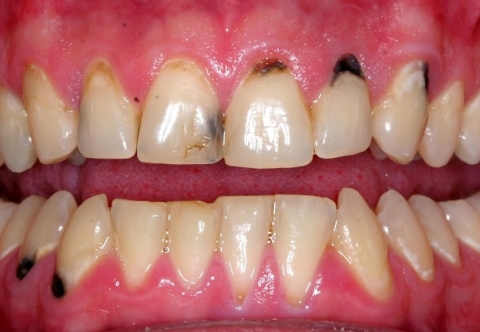 Làm gì khi răng có vết đen? Cách xử lý hiệu quả