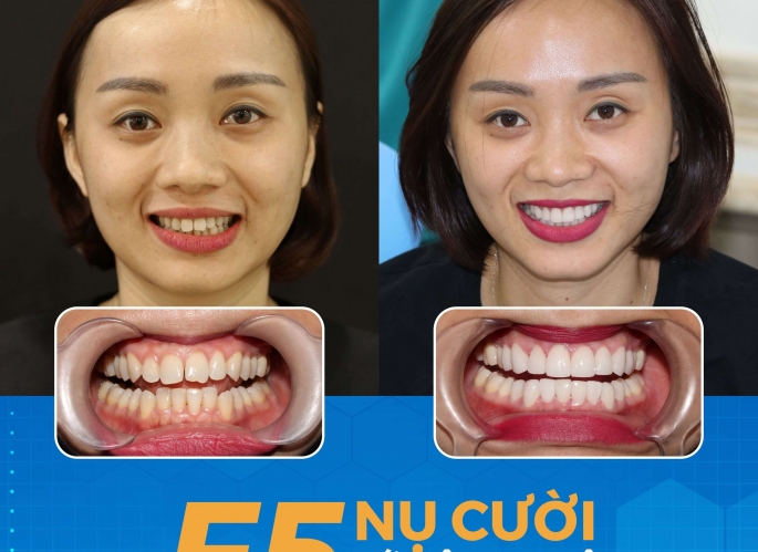Dán sứ Veneer