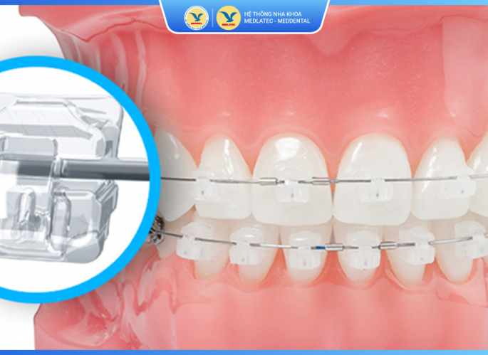 Niềng răng thẩm mỹ 