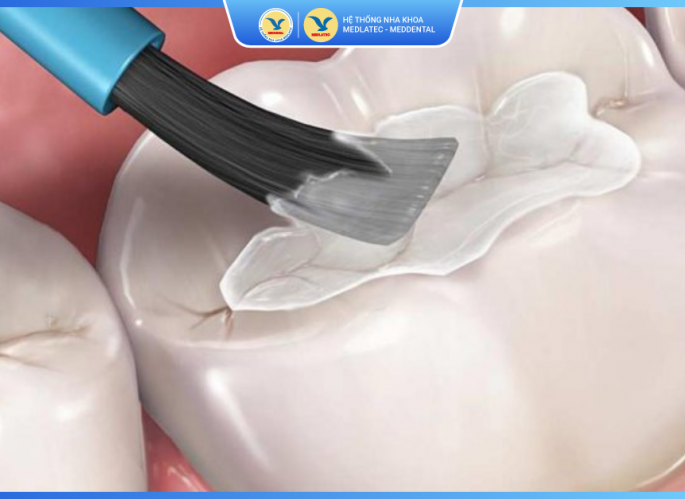 Trám răng thẩm mỹ