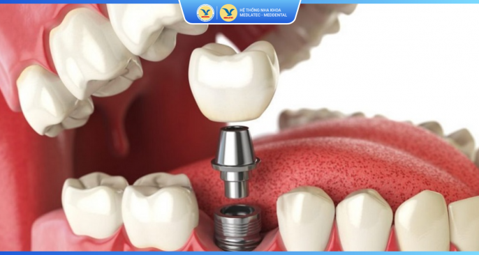 Bảng giá dịch dụ cấy ghép răng Implant 