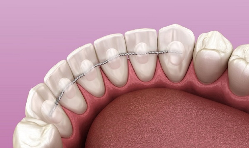 Ưu và nhược điểm của hàm duy trì cố định là gì?