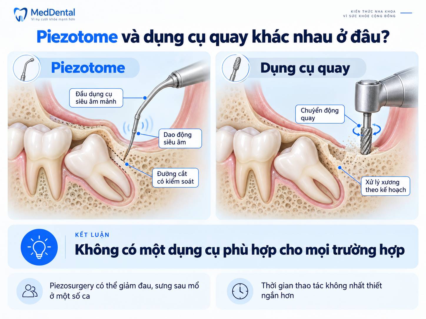 So sánh Piezotome và dụng cụ quay khi xử lý xương quanh răng khôn