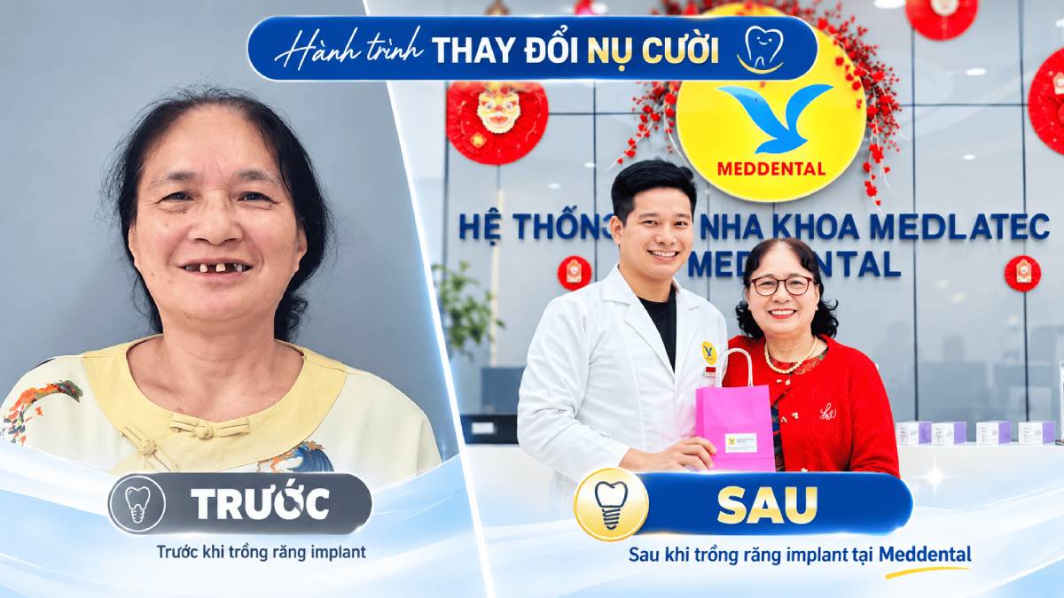 Khách hàng sau điều trị Implant tại MedDental