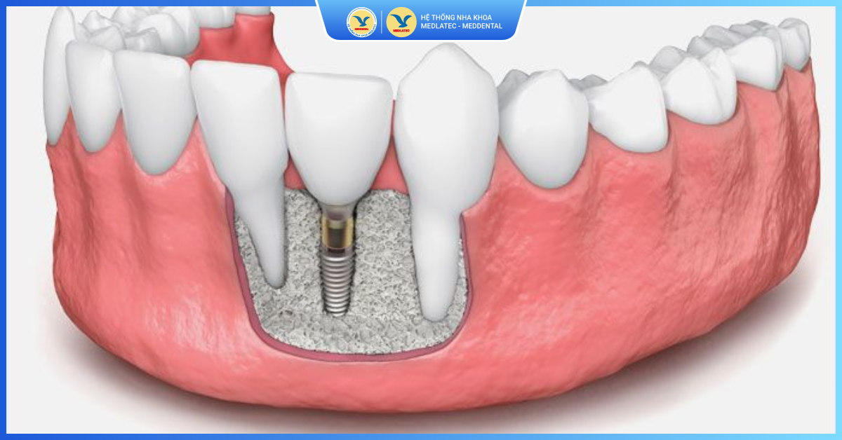 Minh họa vùng ghép xương và những vấn đề cần theo dõi sau phẫu thuật