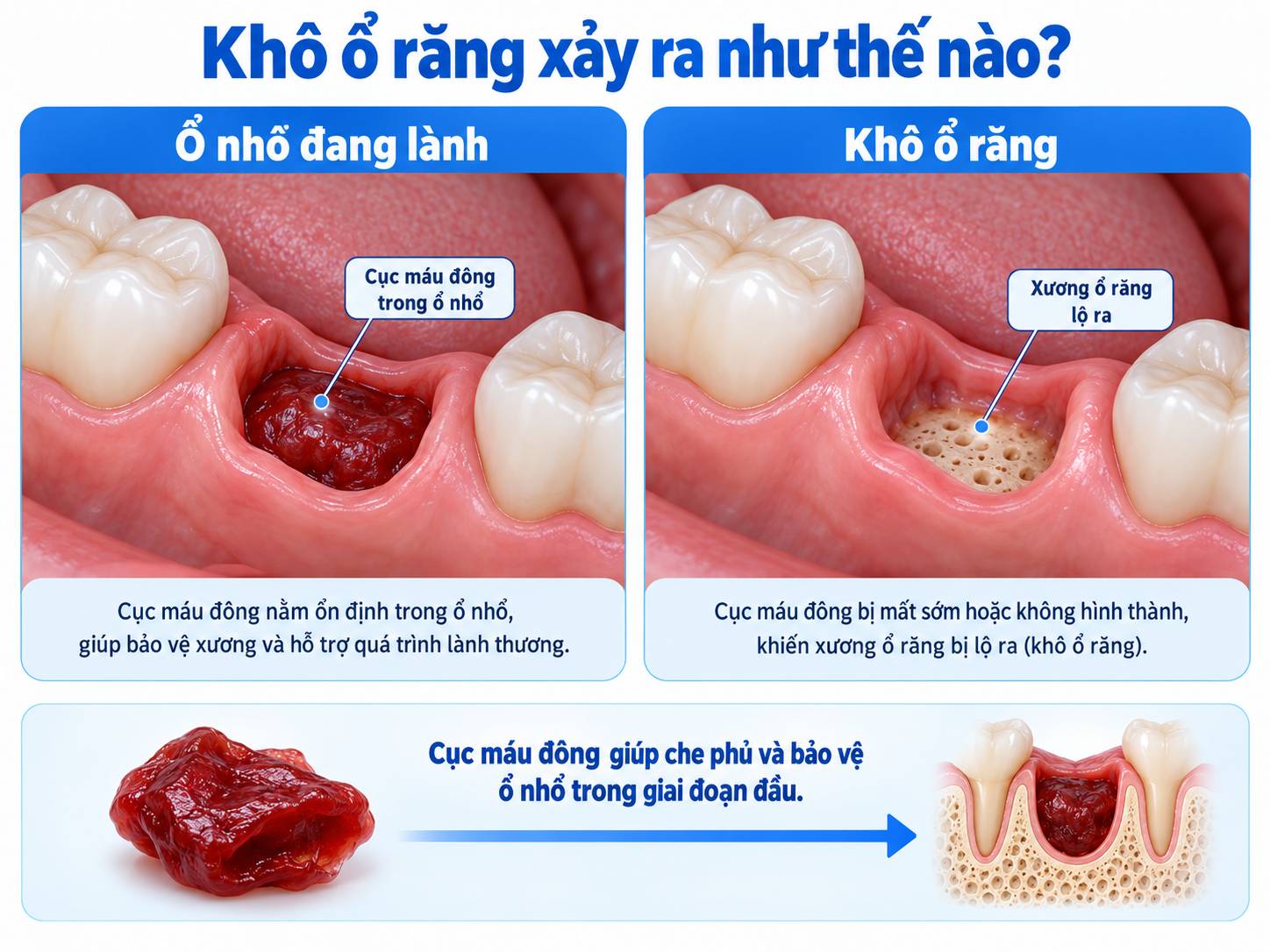 So sánh ổ nhổ đang lành với khô ổ răng sau nhổ răng khôn