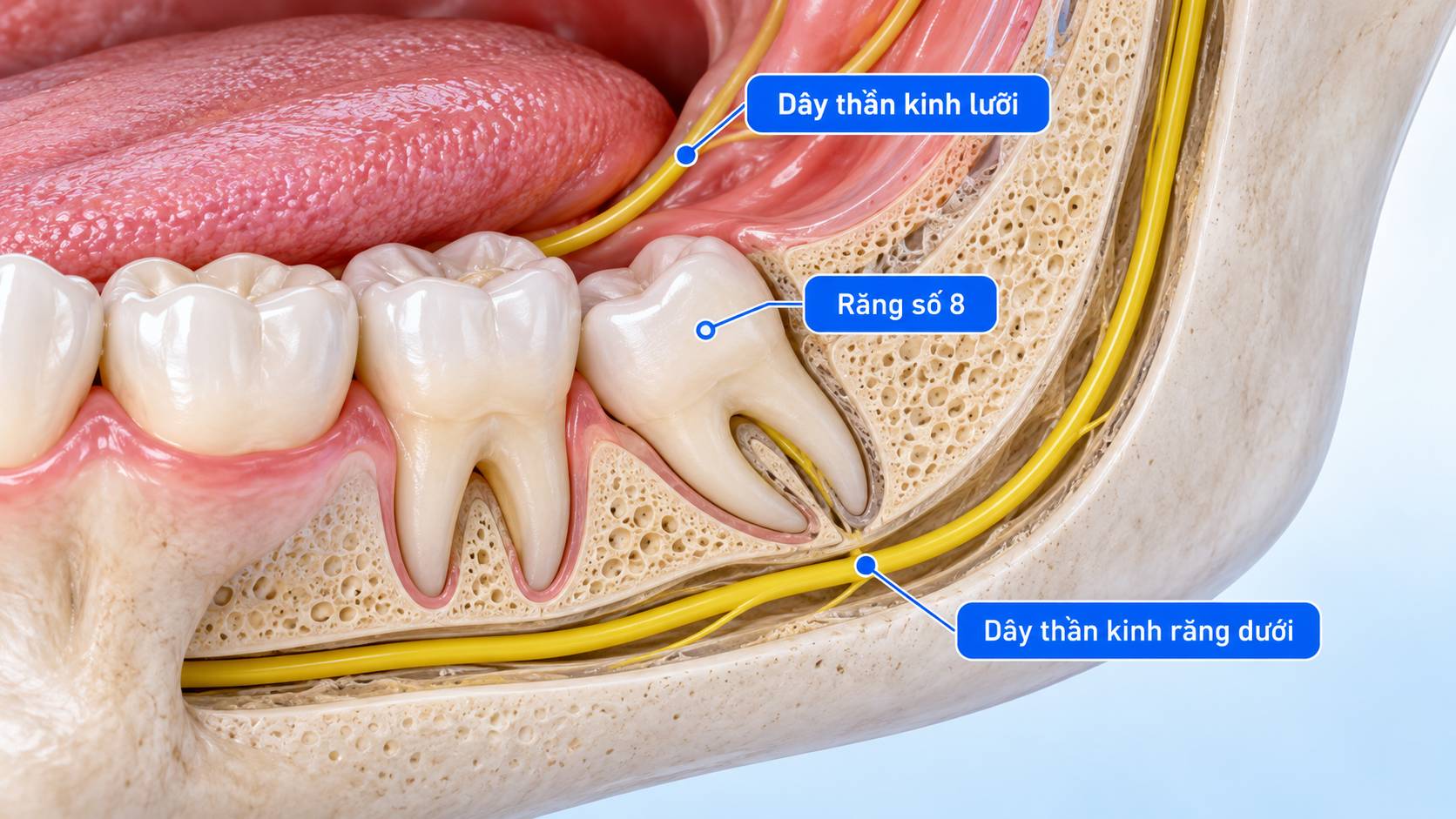 Răng khôn hàm dưới và vị trí dây thần kinh răng dưới, dây thần kinh lưỡi