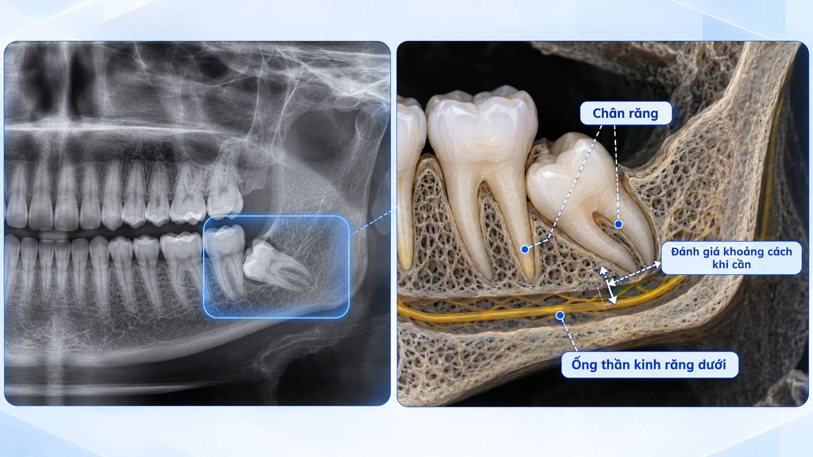 Mối liên quan giữa chân răng khôn hàm dưới và ống thần kinh răng dưới