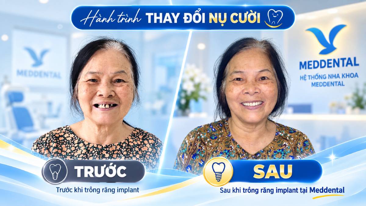 Khách hàng sau phục hình Implant All-on-4 tại MedDental